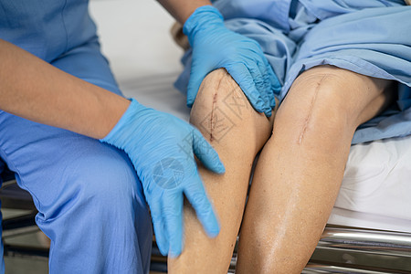 亚洲老年或老年老太太妇女病人在护理医院病房的床上展示她的疤痕手术全膝关节置换缝合伤口手术关节成形术 健康强大的医疗理念纤维治疗危图片