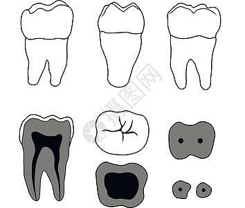 臼齿牙医插图器官牌匾本质空腔搪瓷运河牙周衰变图片