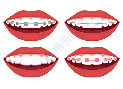 牙齿排列 金属陶瓷塑料绑扎和隐形支具图片