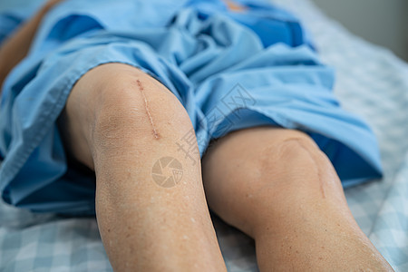 亚洲老年或老年老太太妇女病人在护理医院病房的床上展示她的疤痕手术全膝关节置换缝合伤口手术关节成形术 健康强大的医疗理念治疗外科主图片