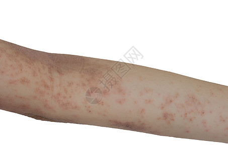 手臂上的皮肤皮疹隔离了白色背景皮肤科疼痛皮炎湿疹疾病女士孩子女孩药品划痕图片