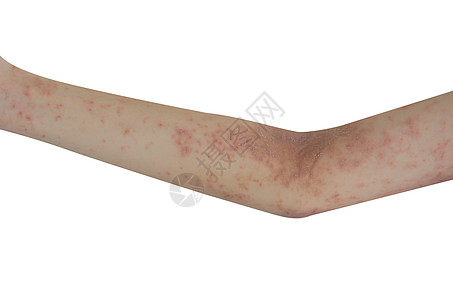 手臂上的皮肤皮疹隔离了白色背景湿疹过敏身体皮炎疾病划痕女性疼痛皮肤科青少年图片