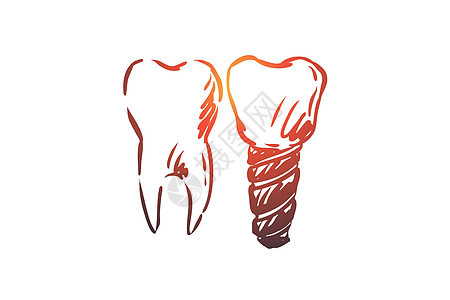 种植牙保健概念 手绘孤立的矢量草图牙医医生技术治疗牙科凹痕搪瓷牙齿插图图片