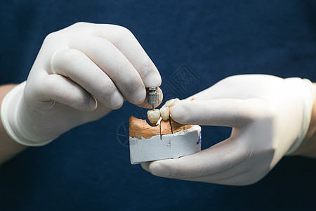石膏模型上植入的陶瓷牙 种植牙上的假肢 骨科牙科的概念 种植体上的陶瓷桥 牙医的手拿着有牙基牙的石膏下巴金属工作服务治疗微笑实验图片
