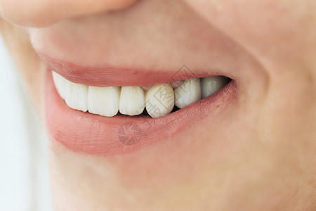 雌性牙齿大型 用锌人造牙贴近的微笑照片 带瓷皮的Zirconia桥图片