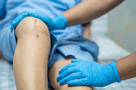 亚洲老年或老年老太太妇女病人在护理医院病房的床上展示她的疤痕手术全膝关节置换缝合伤口手术关节成形术 健康强大的医疗理念瘢痕疾病肌图片