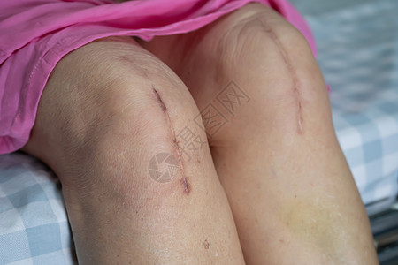 亚洲老年或老年老太太妇女病人在护理医院病房的床上展示她的疤痕手术全膝关节置换缝合伤口手术关节成形术 健康强大的医疗理念解剖学主食图片