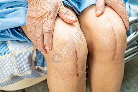 亚洲老年或老年老太太妇女病人在护理医院病房的床上展示她的疤痕手术全膝关节置换缝合伤口手术关节成形术 健康强大的医疗理念瘢痕替代品图片