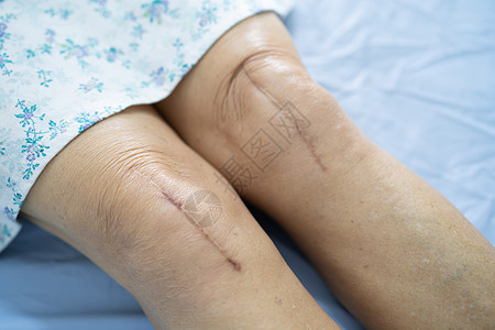 亚洲老年或老年老太太妇女病人在护理医院病房的床上展示她的疤痕手术全膝关节置换缝合伤口手术关节成形术 健康强大的医疗理念瘢痕肌腱退图片