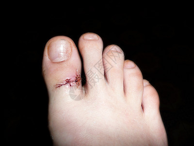 在黑色背景隔离的伤后大脚趾上的外科缝合图片