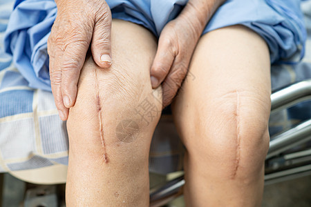 亚洲老年或老年老太太妇女病人在护理医院病房的床上展示她的疤痕手术全膝关节置换缝合伤口手术关节成形术 健康强大的医疗理念纤维皮肤护图片