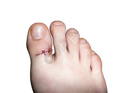 大脚趾上的外科缝线 伤后在白色背景上隔离图片
