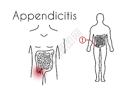年轻马的矢量阑尾炎线性图标图片