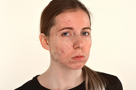 皮肤有问题 阴孔问题概念的年轻美少女治疗化妆品青少年疾病黑头面具皮肤科女士女孩女性图片