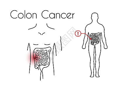 年轻人矢量科朗癌症线性图示图片