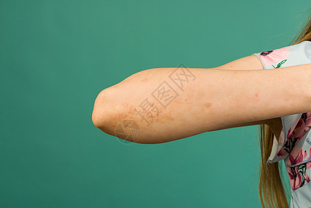 CLOSE UP 患有自发免疫不治之皮肤病称为psoralpic的无法辨认的年轻女性真菌昆虫蚊子损害治疗划痕牌匾补丁皮脂疾病图片