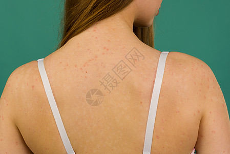 CLOSE UP 患有自发免疫不治之皮肤病称为psoralpic的无法辨认的年轻女性湿疹昆虫治疗划痕结痂真菌皮疹奶油疾病女士图片