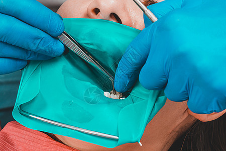 牙医用橡胶大坝 钻孔 镜子来治疗病人的牙齿卫生治愈器械程序诊所口腔科矫正乐器技术橡皮障图片