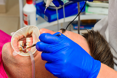 牙科医生用超声波去掉薄凝油层的测深仪治疗牌匾鞑靼卫生口服保健乐器望远镜病人诊所图片