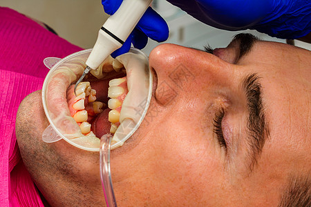 牙科实践 牙医在超声波的帮助下去除牙齿上的结石和硬斑块 患者口腔内有牵引器和唾液喷射器药品工具医生矫正手术口服镜子诊所无菌器械外图片