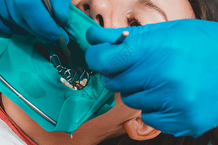 借助橡皮障系统 通过光聚合物填充材料修复咀嚼面男人牙科围堰医生框架口腔科牙齿卫生疾病医疗图片