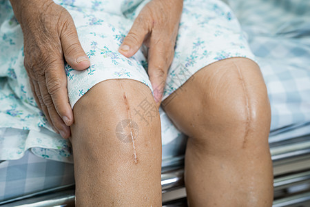亚洲老年或老年老太太妇女病人在护理医院病房的床上展示她的疤痕手术全膝关节置换缝合伤口手术关节成形术 健康强大的医疗理念纤维解剖学图片