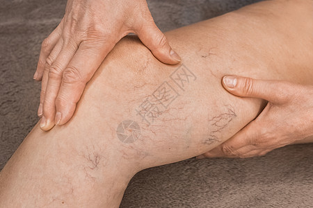一位年长女性的手在变动血管上展示 生病的女性双腿皮肤身体痛苦静脉病人浮肿肿胀蜘蛛血栓外科图片