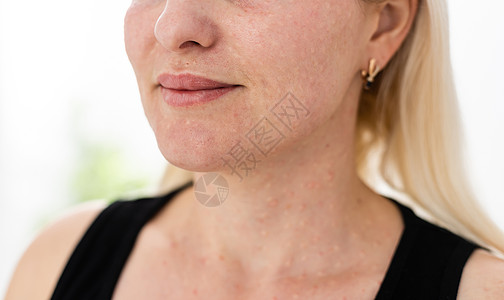 女人的脸 皮肤的质地女士疙瘩毛孔疾病黑头疤痕感染瘢痕胶原女性图片