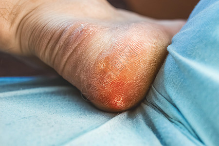 男人的腿和玉米 关上门来 笑声真菌医生卫生剥皮美容脚跟状况康复痛苦组织图片