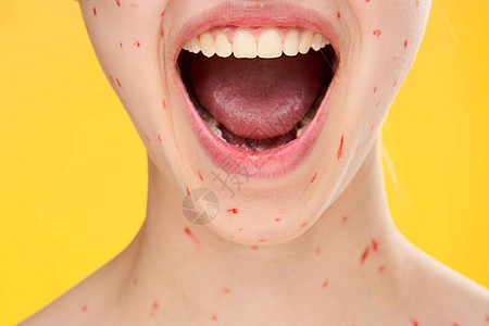女性脸部皮肤问题红点的女脸部疾病鳗鱼黑头爸爸伤口刺激拉丁疙瘩肩膀青春痘图片