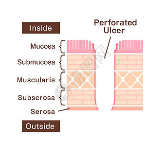 剖面溃疡截断视图插图诊断横截面溃疡癌症图表侵蚀肿瘤感染药品身体图片