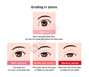 分解矢量图示的分级卡通片眼皮肌肉外科眼球线条成人医生眼睛年龄图片