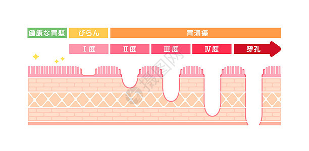 胃溃疡胃溃嗽器肠胃溃疡阶段矢量插图胃炎侵蚀图表感染肿瘤风险食管药品粘膜癌症图片