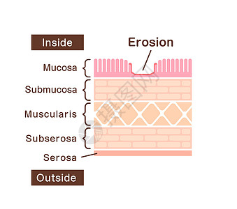 胃侵蚀的剖面图解说明图表风险疾病感染横截面疼痛外科肿瘤身体诊断图片