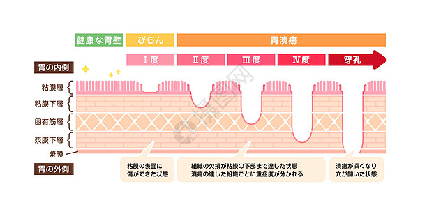 胃溃疡胃溃嗽器肠胃溃疡阶段矢量插图解剖学胃炎疾病食管器官手术消化溃疡侵蚀浆膜图片