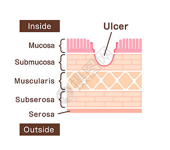 胃溃疡的分区视图插图肿瘤手术侵蚀解剖学疾病身体生物学诊断食管图表图片