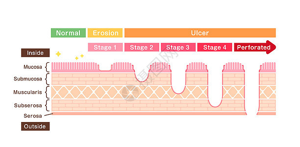 胃溃疡胃溃嗽器肠胃溃疡阶段矢量插图风险食管疾病器官身体生物学诊断药品粘膜外科图片