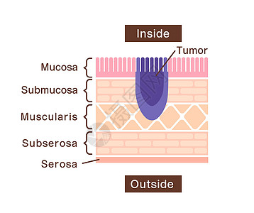 胃癌 胃癌 的剖面图说明生物学科学外科药品细菌肠胃疼痛胃炎消化食管图片