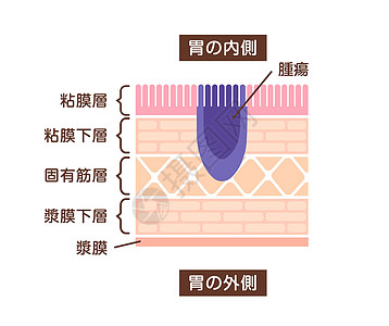 胃癌 胃癌 的剖面图说明解剖学消化组织生物学食管横截面药品科学侵蚀溃疡图片