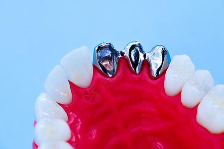植牙和安装树冠工艺程序磨牙假牙医生蓝色外科手术牙科技术诊所工具图片