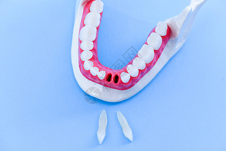 植牙和安装树冠工艺程序牙科牙齿单板药品牙医诊所假牙卫生外科蓝色图片