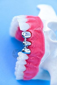 植牙和安装树冠工艺程序卫生假牙治疗磨牙单板教学手术牙齿口服工具图片