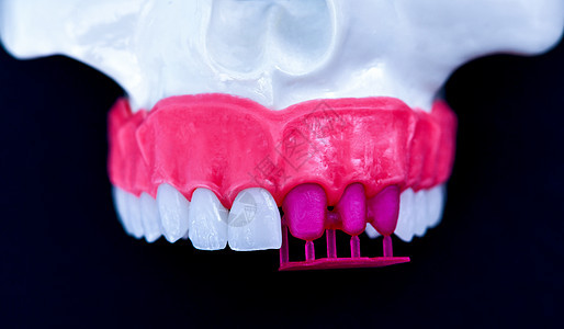 植牙和安装树冠工艺程序药品假牙假肢教学磨牙手术牙齿单板替代品牙医图片