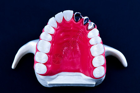 植牙和安装树冠工艺程序工具牙科假肢外科教学药品矫正替代品单板医生图片