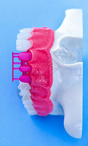 植牙和安装树冠工艺程序牙齿植入物外科牙龈蓝色矫正教学技术牙医治疗图片