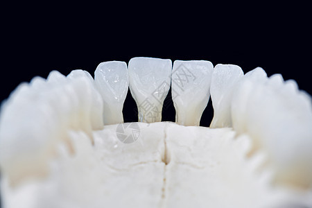 下人下下下巴 其牙齿在黑色背景上被隔绝矫正塑料实验室技术医生外科治疗口腔科假肢牙科图片