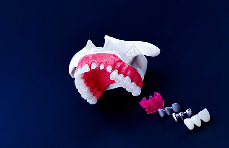 植牙和安装树冠工艺程序牙龈蓝色牙医假牙单板植入物替代品矫正口服工具图片