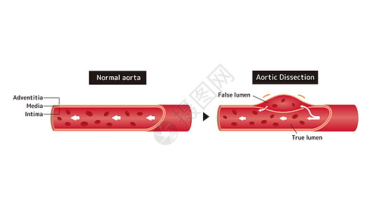正常动脉和张动脉解剖的比较说明图片