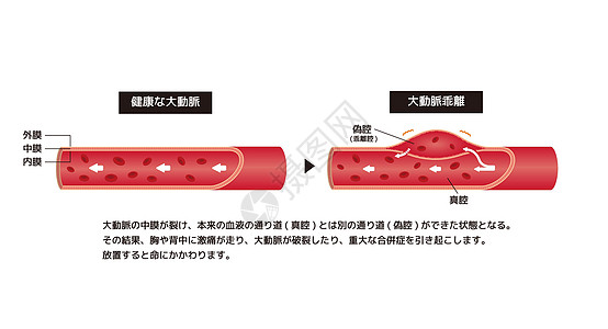 正常动脉和厌食解剖的比较说明日本主动脉假腔心血管外科视图血管药品插图胸部治疗图片