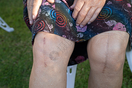 外科手术完全取代了膝盖的合用替换器 她身上的伤疤身体痛苦切口药品替代品金属成形术危险关节疾病图片